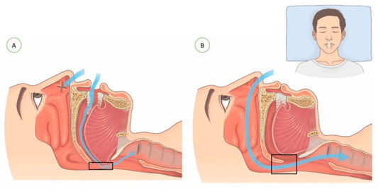 New Research Study Finds Mouth Taping May Improve Sleep Apnea